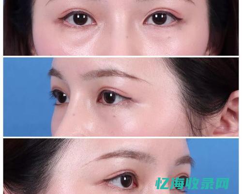 成都做眼袋手术哪家医院好