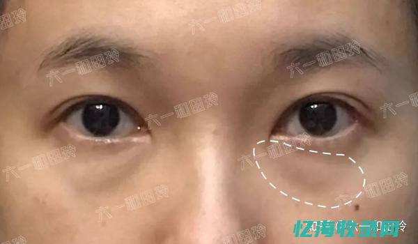成都做眼袋手术价格